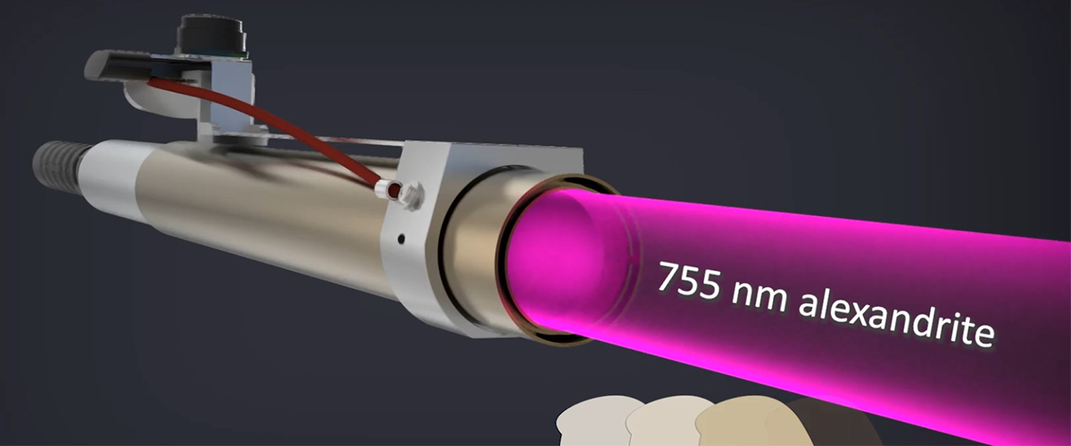 alexandrite laser