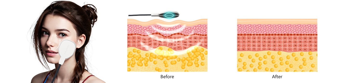 Face Lifting, Reduce Wrinkle, Skin Tightening