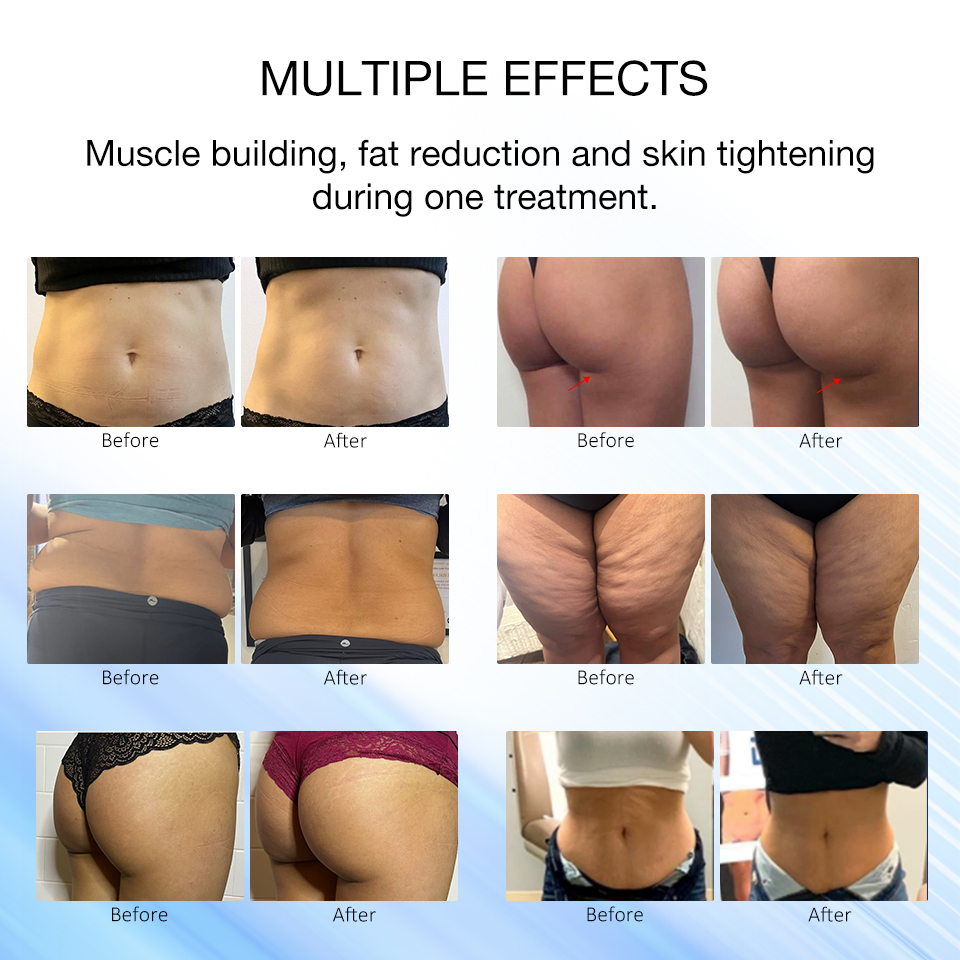 Renasculpt FE80 Professional Emslim Machine for Fat Burning
