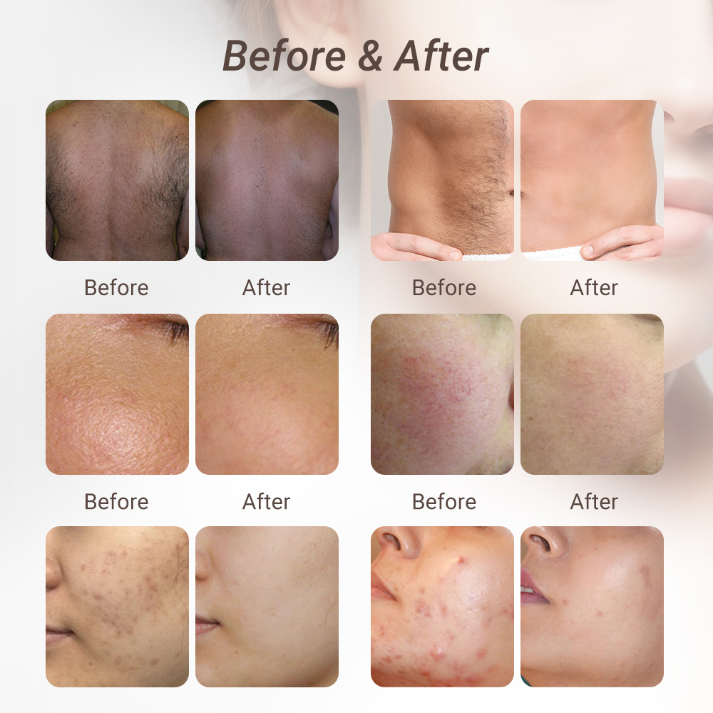 Máquina portátil para el cuidado de la piel con láser NIR DPL