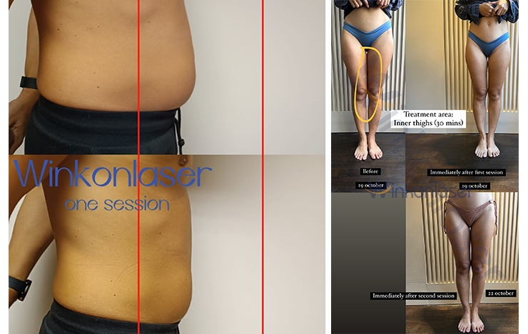 renaface before and after